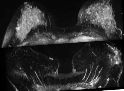 gadolinium beadását