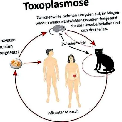 giardiasis
