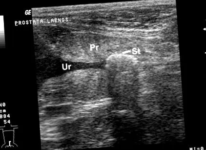 urolitok