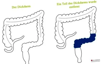 colostomie