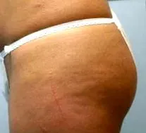 injectabilă