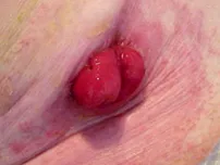 stoma
