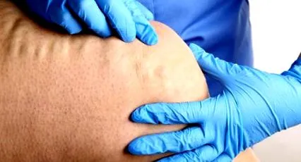 definirea prevenirea