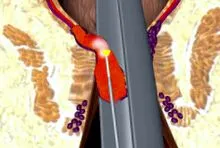 terapia hemoroizilor