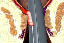 terapia hemoroizilor