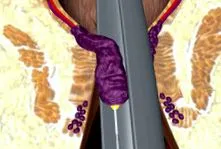laser hemoroizilor