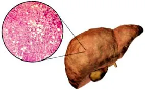 steatoza