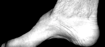 charcot-marie-tooth