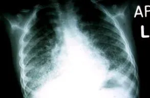 alveoláris
