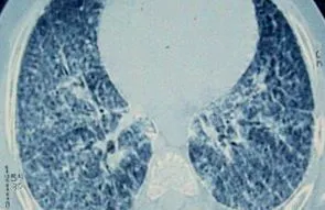pulmonalis