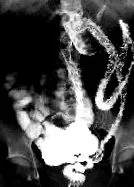 crohn