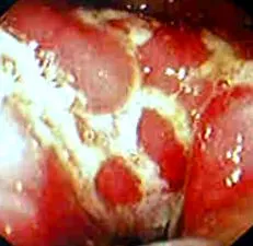 crohn