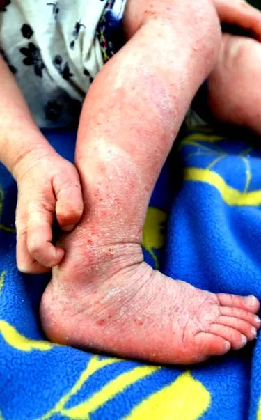 neurodermatitis
