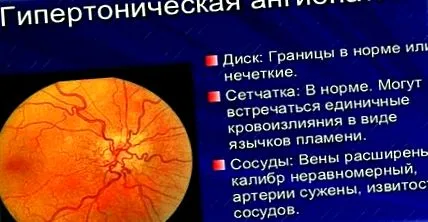 ангиопатија причини