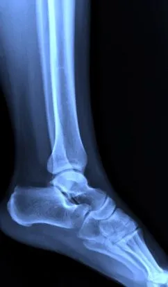 osteochondrosis