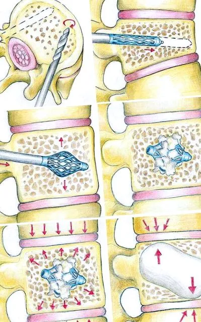 osteoporosis