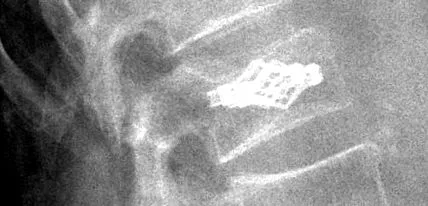 osteoporosis