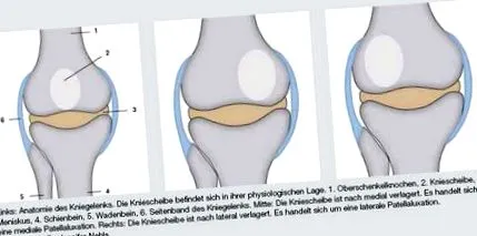 patellar terápia