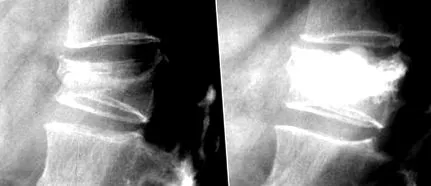 osteoporosis