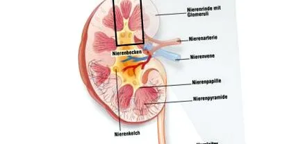 pyelonephritis