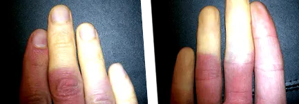 raynaud-szindróma