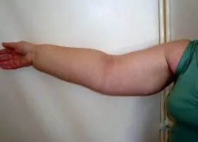 umflarea