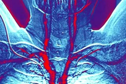 thrombus