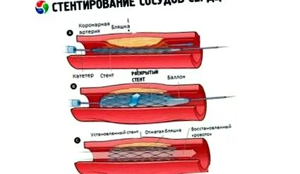 последици