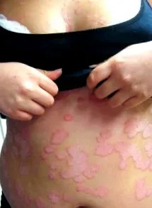 Acad Dermatol terápia