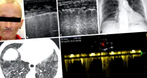 pulmonalis artériás