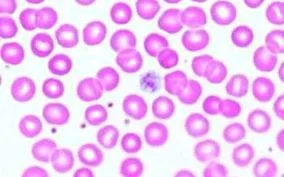 thrombocytopenia