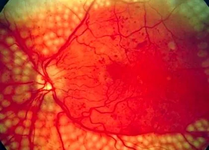 retina angiopathia tipp retina