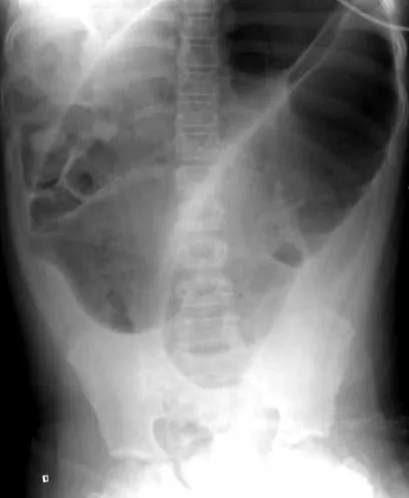 volvulus