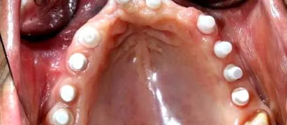 secundare