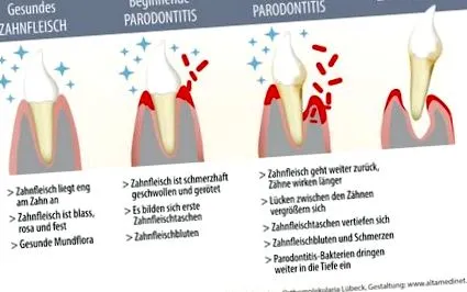 parodontális
