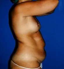 abdominoplastie