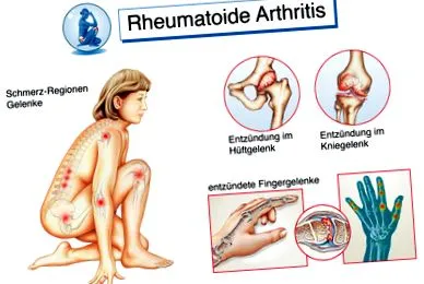 arthritis