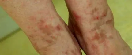 purpura purpura