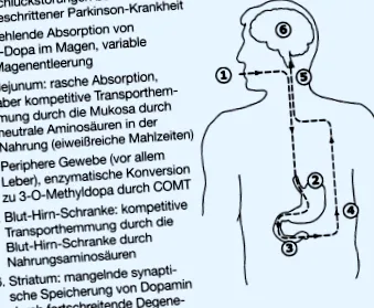 parkinson