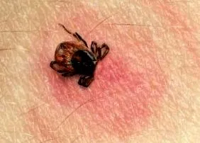 lyme