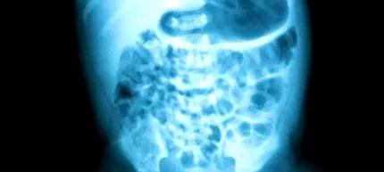 intestinale terapie