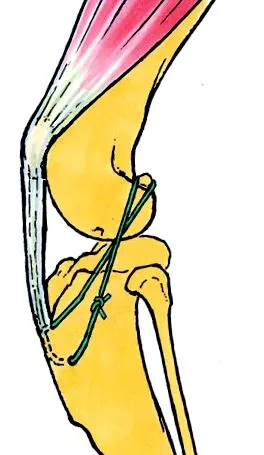 ligamentul