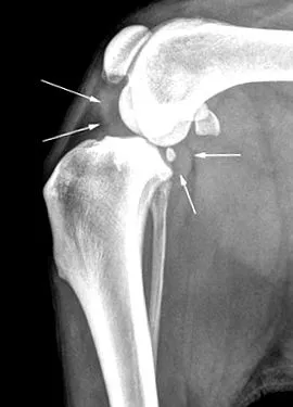ligamentul
