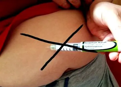 cukorbetegség