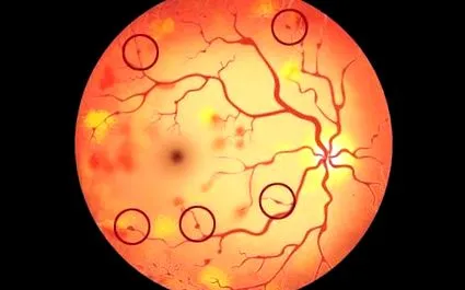 retinopátia Cukorbetegség útmutató