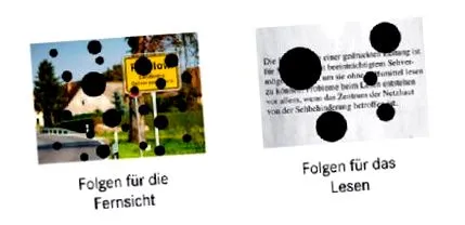 proliferatív retinopathia Cukorbetegség útmutató