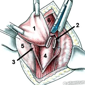 epiphrenic diverticula