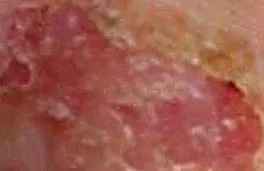 dyshidrosis