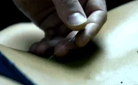 акупунктура