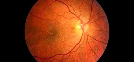 epiretinală
